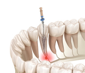 Endodontic root canal treatment process. Medically accurate tooth 3D illustration. - obrazy, fototapety, plakaty