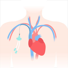 Tunneled central venous catheter placed in the subclavian vein. Patient with CVC long term access device for chemotherapy infusions and blood sampling. Central line tube close up. Vector illustration.
