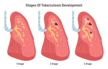 Stages of tuberculosis development. Respiratory system disease. Human lung