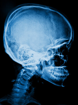 x ray image of human skull