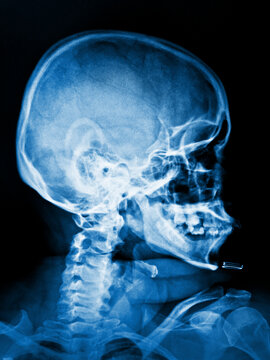 x ray image of human skull