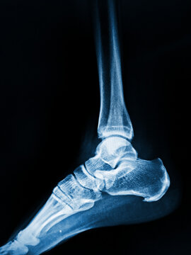 x ray image of ankle