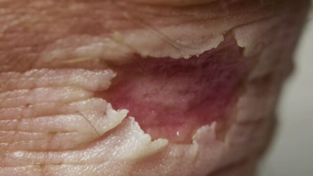 Large deep callus on Achilles after a long walk