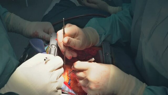 Procedure of coronary artery bypass graft CABG for the operation a heart due to coronary heart disease in an operating room in hospital