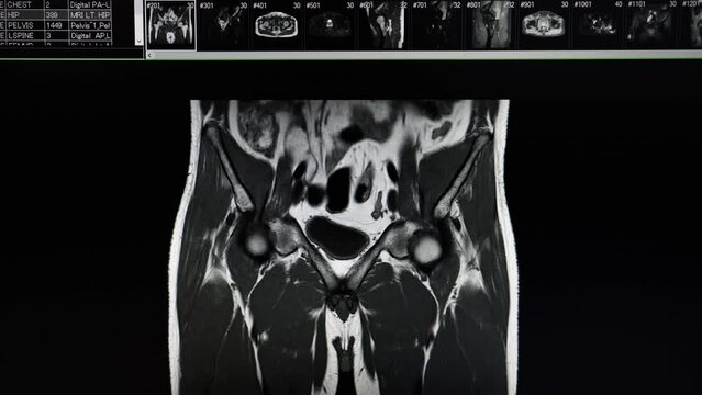 Hip MRI scan showing left side pyomyositis and intramuscular abscess at left iliacus and gluteus muscles.