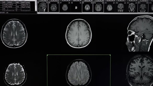 Brain MRI or nuclear magnetic examination of a patient.,