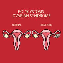 POLYCYSTIC OVARIAN SYNDROME VS NORMAL Female Reproductive System Cells Similar To Lining Of Uterus Grow Outside For Medical Education Diagram Human Anatomy