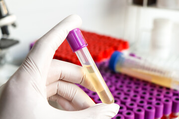 Urine test to look for abnormalities from Urine,  Urine sample to analyze in the laboratory