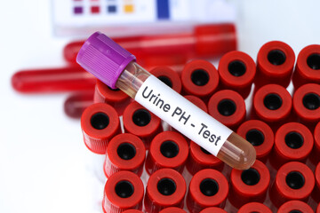 Urine PH test to look for abnormalities from Urine,  Urine sample to analyze in the laboratory