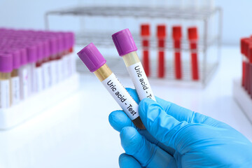 Uric acid test to look for abnormalities from Urine,  Urine sample to analyze in the laboratory