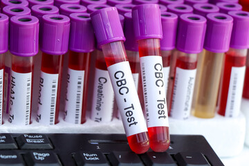 CBC test to look for abnormalities from blood,  blood sample to analyze in the laboratory