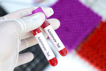 autoimmume test to look for abnormalities from blood,  blood sample to analyze in the laboratory