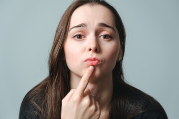 Fototapeta premium Virus herpes on lips close-up. Unhappy woman shows on a painful swollen lips. Portrait of young beautiful girl of European appearance with infection injury. Dermatology sickness. Facing treatment