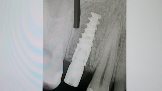 Black and white roentgen of teeth. Dentist uses pen to point at area with implant in jaw. X-ray image. Dentist examines dental arch on computer screen. Missing teeth. 4 k video