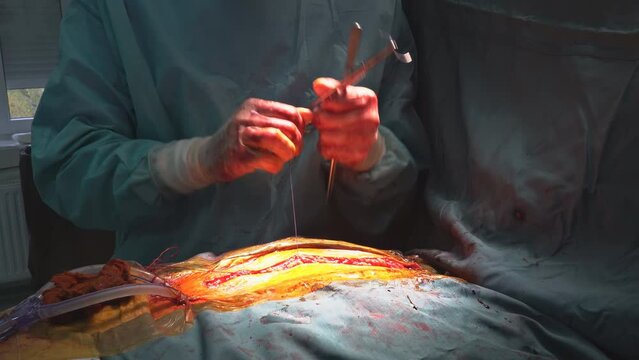 Coronary artery bypass graft CABG is performed in the hospital operating room for treatment of heart diseases because coronary heart disease.