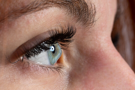 Female eye affected by keratoconus, or conical cornea