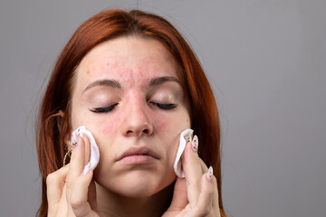 Face of a woman removing make-up, red due to intolerances and allergies