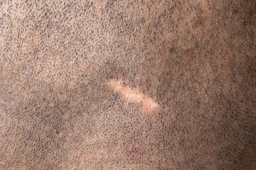 Scar on the scalp of a man with shaved hair