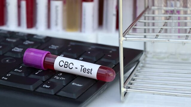 CBC test to look for abnormalities from blood,  blood sample to analyze in the laboratory, blood in test tube
