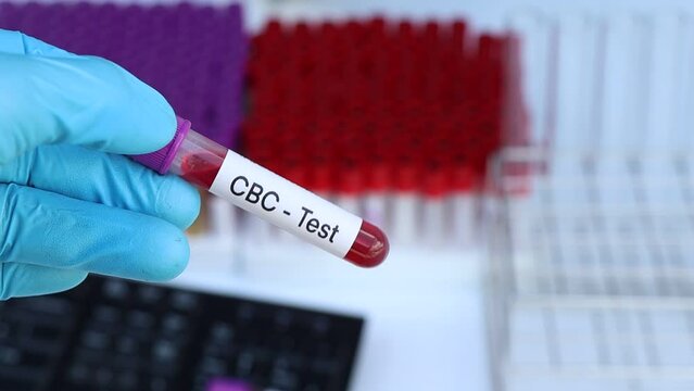 CBC test to look for abnormalities from blood,  blood sample to analyze in the laboratory, blood in test tube