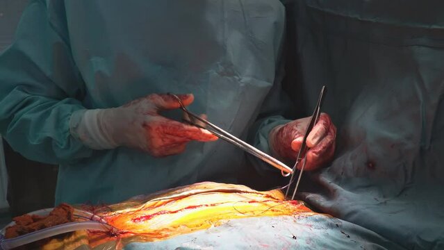 Valve replacement is performed in operating room when a malfunctioning valve the heart causes an open heart surgery