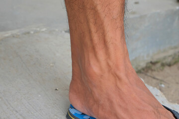 Veins in men's legs. Closeup shot of male leg, Concept illustration of healthcare, pedology or...