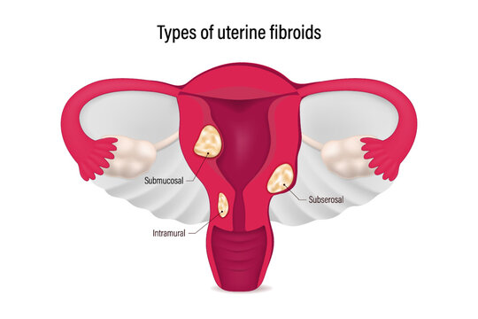 Types of uterine fibroids. Submucosal, Subserosal and Intramural fibroids. Female reproductive system.