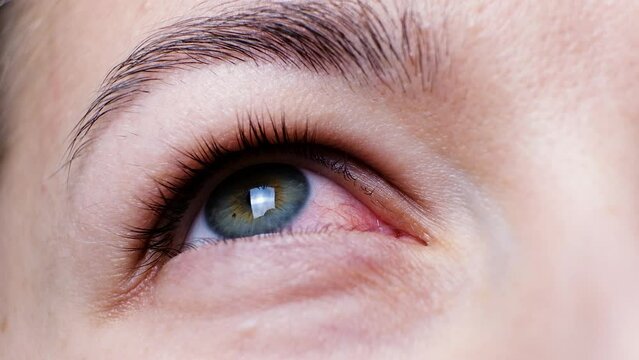 Close up of a severe bloodshot red eye. Viral Blepharitis, Conjunctivitis, Adenoviruses. Irritated or infected eye