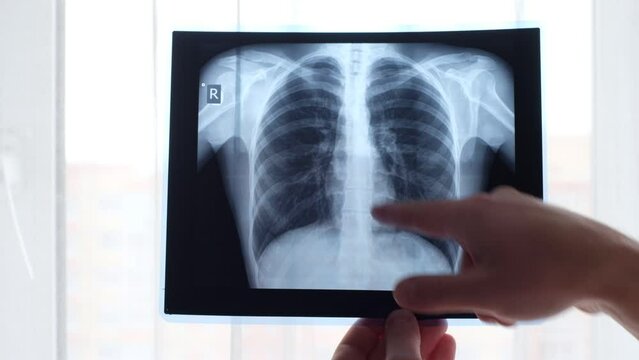 Lung radiography concept. Radiology doctor examining at chest x ray film of patient Lung Cancer or Pneumonia. Virus and bacteria infected the Human lungs. Patient with Lung Cancer or Pneumonia.
