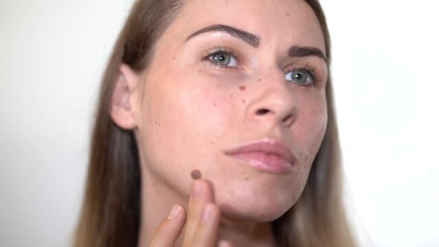 Young woman worried about moles on her face. Girl touching a big mole on her face