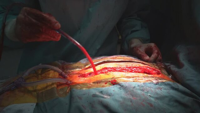 During open heart surgery, if heart valve malfunctions, valve replacement is performed in the operating room to resolve this issue