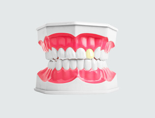 Obraz premium Jaw with white healthy teeth and one unhealthy tooth with caries, yellow rotten color