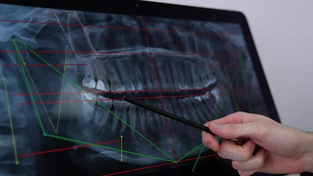 Macro shot of x-ray picture of denture on the screen of computer. Doctor’s hand pointing at teeth with a pencil. Close up.