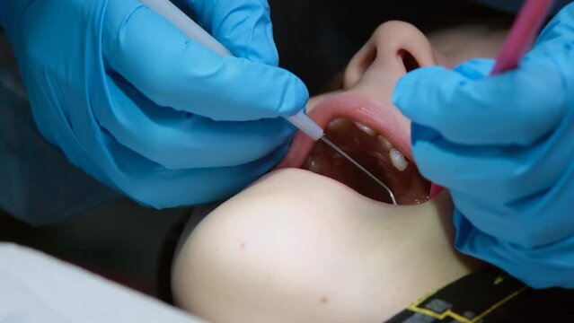 Close up shot of professional scaling kid teeth. Dental hygiene. Teeth tartar and calculus deep cleaning. Professional teeth cleaning. Teeth treatment in child dental cabinet. Work Dentist. Healthcare