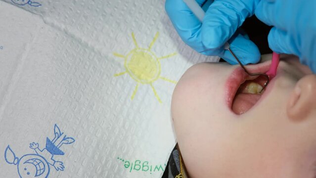 Close up shot of professional scaling kid teeth. Dental hygiene. Teeth tartar and calculus deep cleaning. Professional teeth cleaning. Teeth treatment in child dental cabinet. Work Dentist. Healthcare