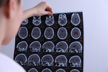 Doctor examining MRI images of patient with multiple sclerosis in clinic, closeup