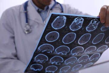 Doctor examining MRI images of patient with multiple sclerosis in clinic, closeup