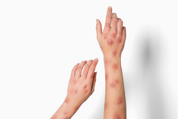 Woman with rash suffering from monkeypox virus on white background, closeup