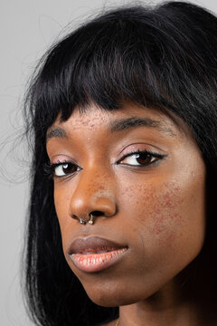 Face of African girl suffering from rosacea, redness of cheeks and acne