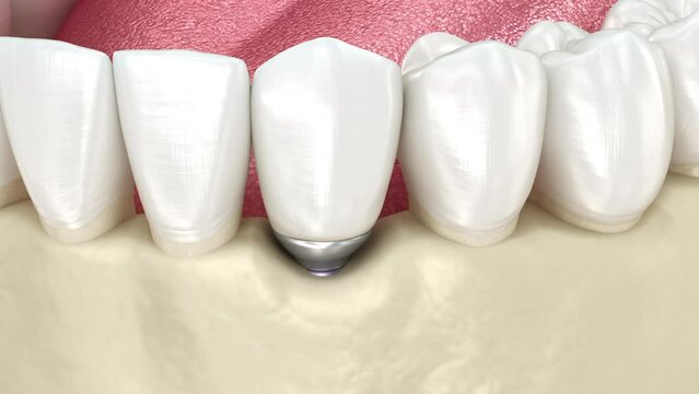 Peri-implantitis and gingiva recession. Dental 3D animation