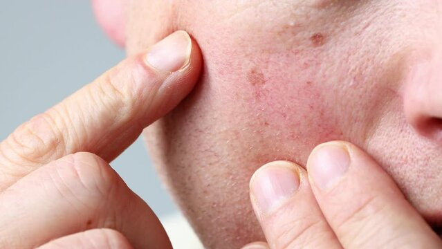 Reddened face, broken capillaries, health problems, sensitive skin with broken veins