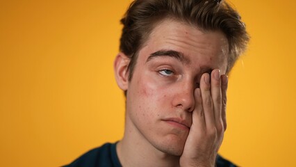 Closeup of sick tired headache migraine exhausted displeased young man 20s posing isolated on yellow background studio. Put hands on head