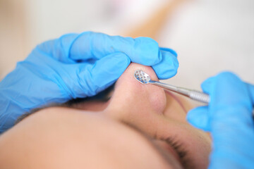 Close up, mechanical cleaning of the face around the nose patient spa salon using an extractor