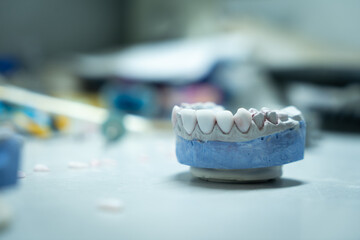 creation of dental veneers by a dental technician