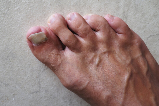 Toenail peel away with parts splitting or broken off.