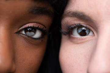 Heterochromia in light eye and dark eye