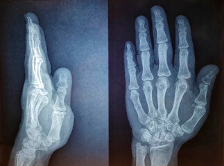 X-Ray of human hand, radiography of hand bones, infected bone in the thumb, top view