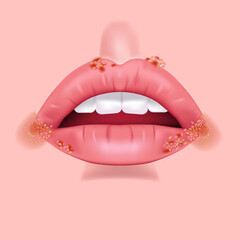 rash on lips, herpes. Pimples and ulcers on the face. Open mouth with teeth. Vector illustration