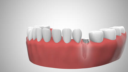Dental implant in the gum