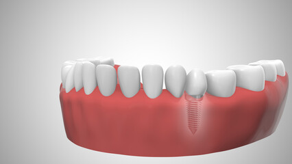 Dental implant in the gum